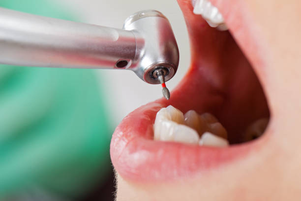 Best Urgent Care for Lost Fillings or Crowns in La Vale, MD